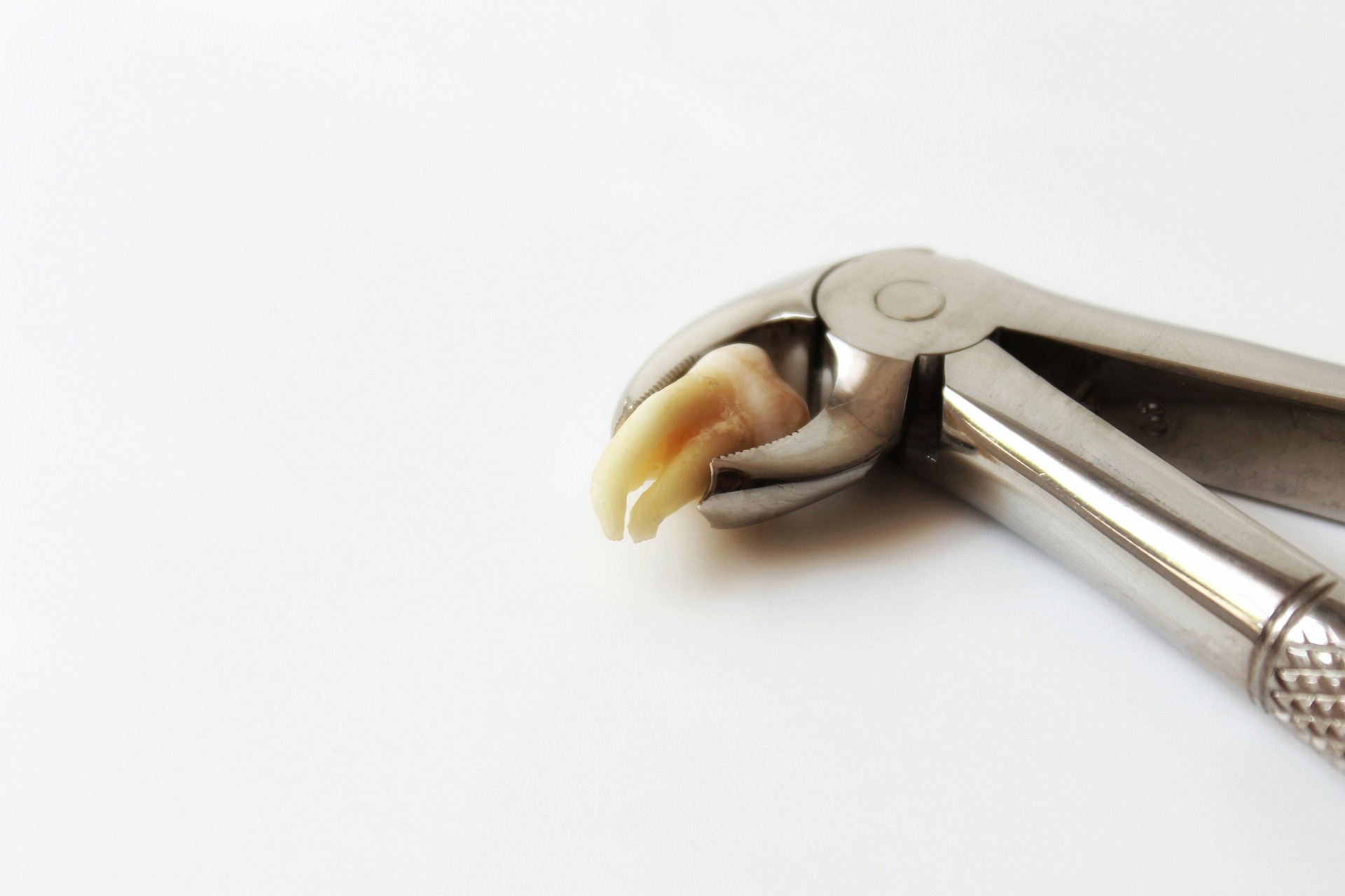 When is a Dental Extraction Necessary?