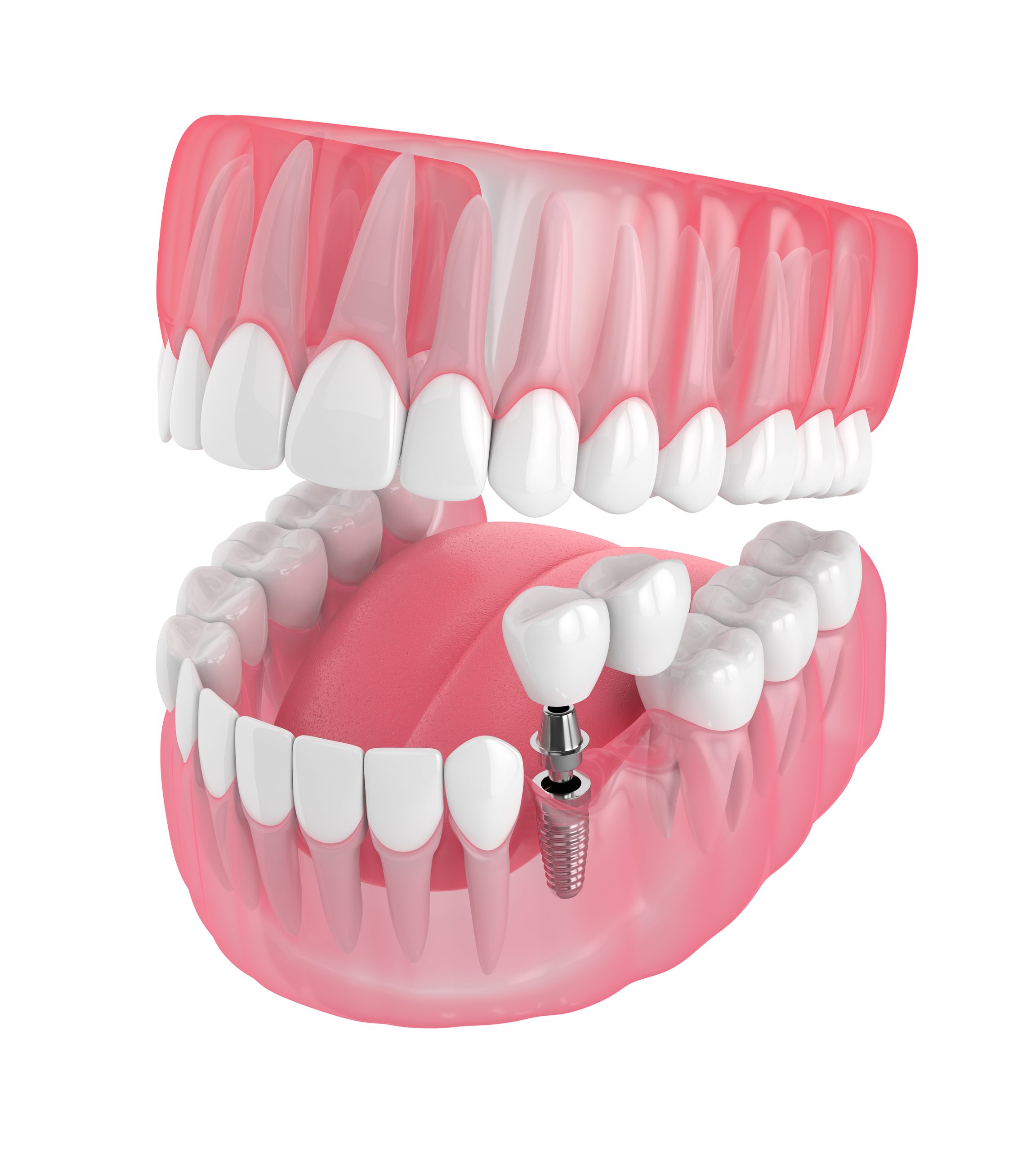 Dentures and Implants: Best Restorative Dental Treatments