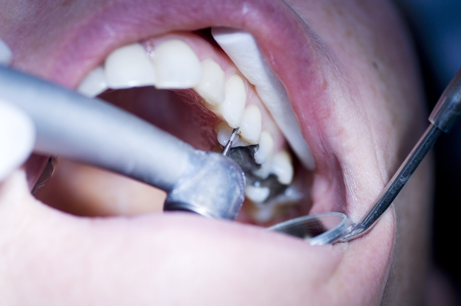 Comprehensive Guide to Dental Fillings in Kansas City, KS: Everything You Need to Know